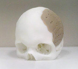 3-D-printed skull implant
