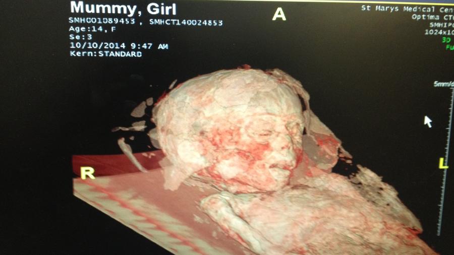 Doctors think mummy died of appendicitis  900x506