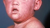 Some doctors are flubbing measles diagnoses: Here's why