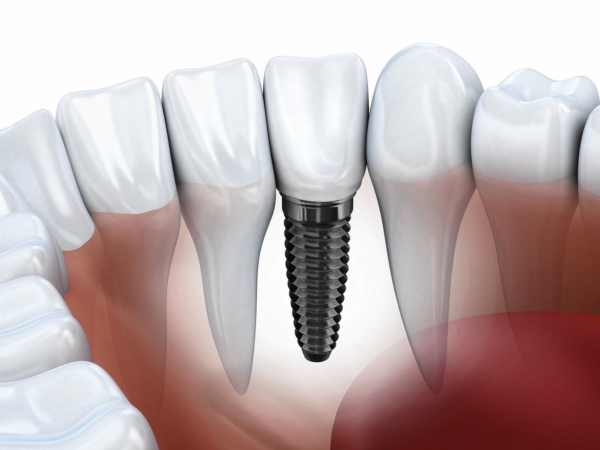 sc-hlth-0715-dental-implants-20150709