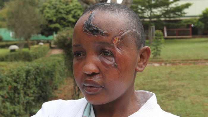 Jackline Mwende said her husband attacked her with a machete because she hadn't produced children.