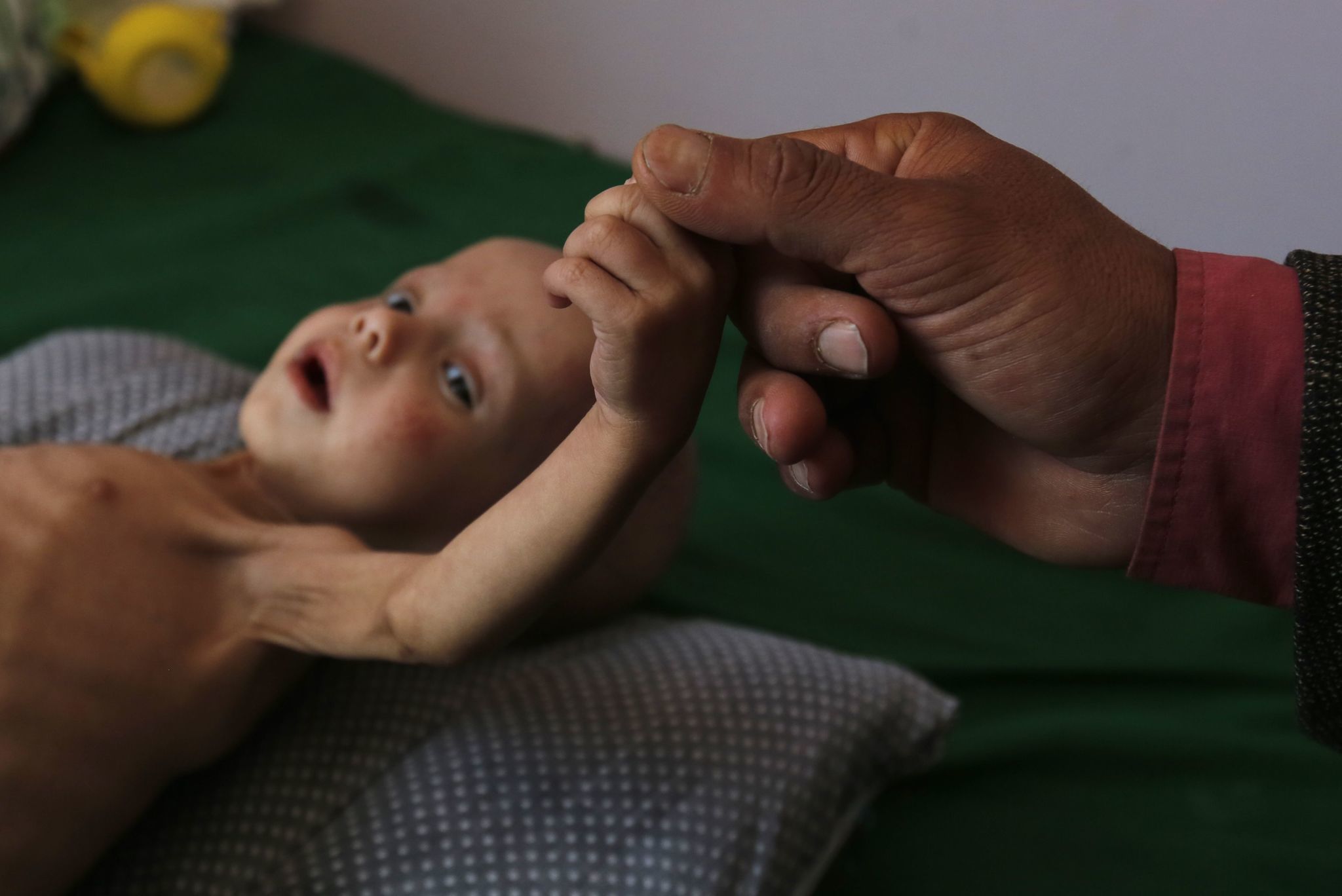 Image result for 50,000 CHILDREN IN YEMEN HAVE DIED OF STARVATION AND DISEASE SO FAR THIS YEAR, MONITORING GROUP SAYS
