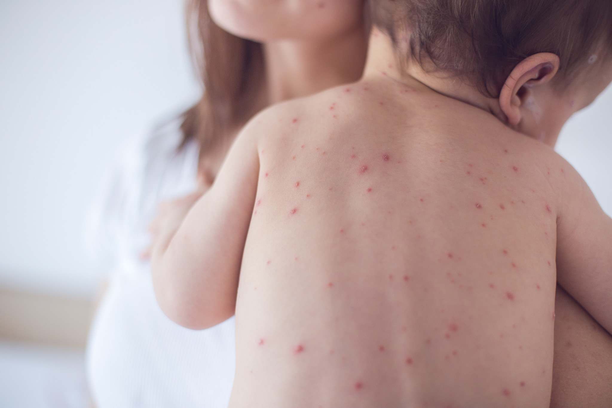 More than 140,000 measles deaths last year leaves health officials outraged