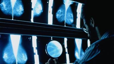 New method for predicting breast cancer risk suggests about 30% of cases could be prevented