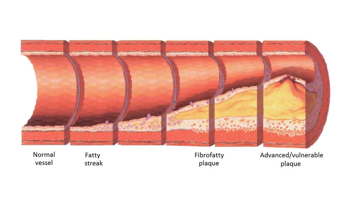 Толстая стенка сосуда. Атеросклеротическая бляшка. Накопление холестерина в сосудистой стенке. Накопление холестерина в сосудистой стенке атеросклеротическая.