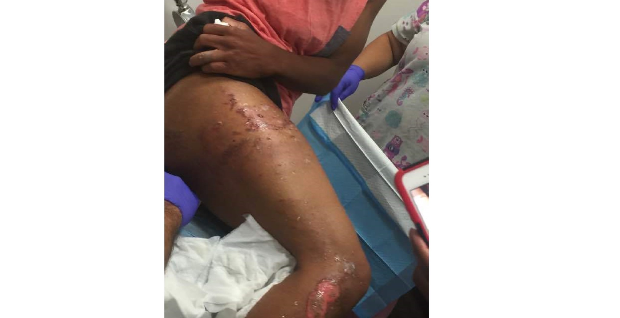 Tatyana Hargrove says she was attacked by a Bakersfield police dog after she mistaken for male suspect.