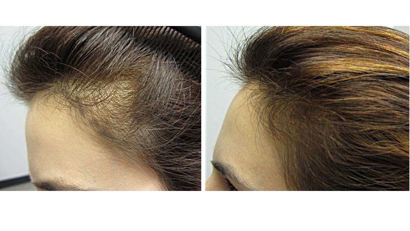new research in hair regrowth