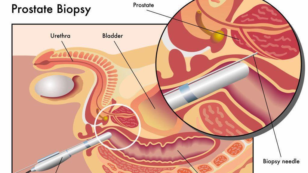 Biopsia prostatica transperineala